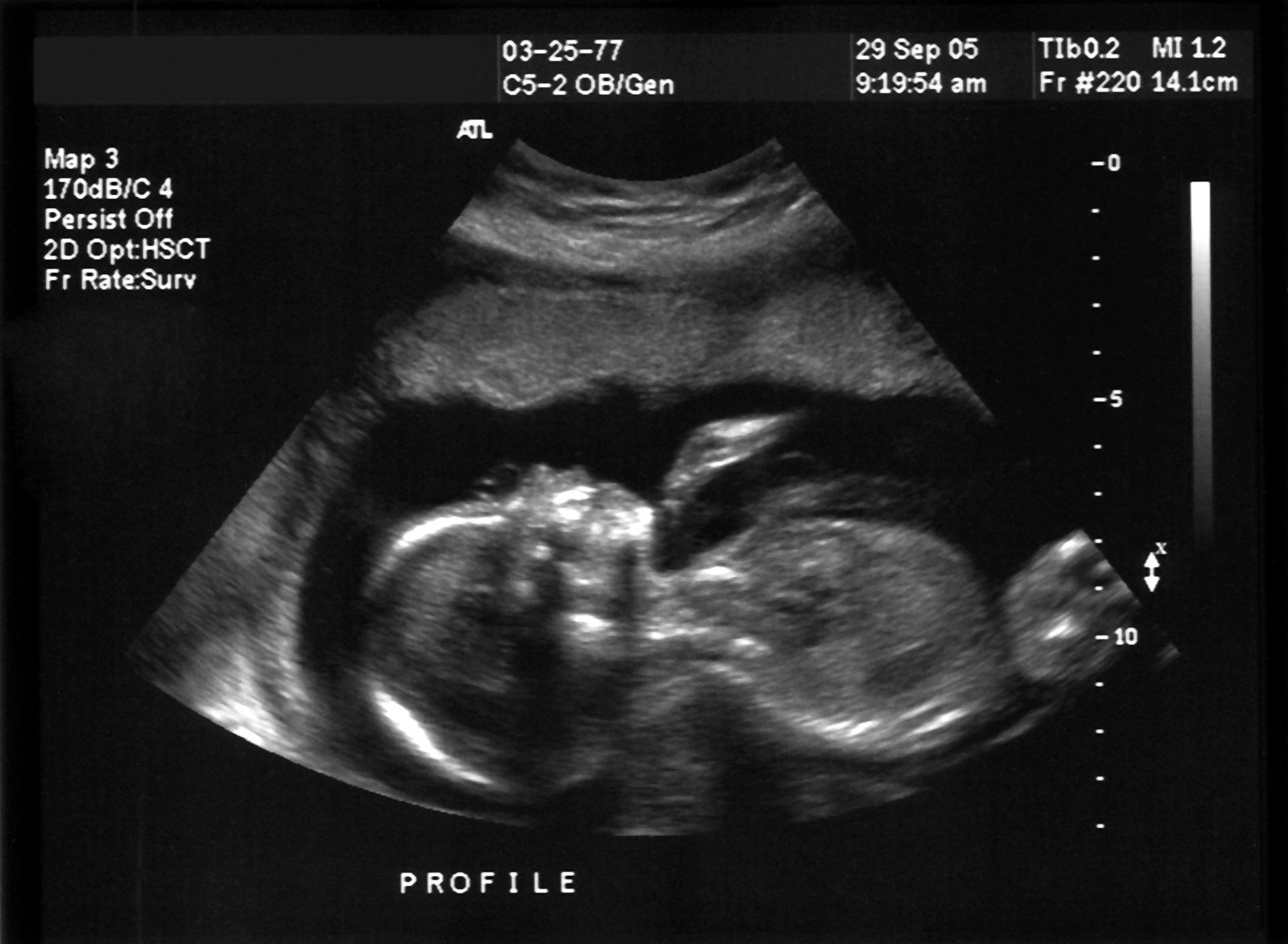 Ultrasound scan of a foetus in the womb