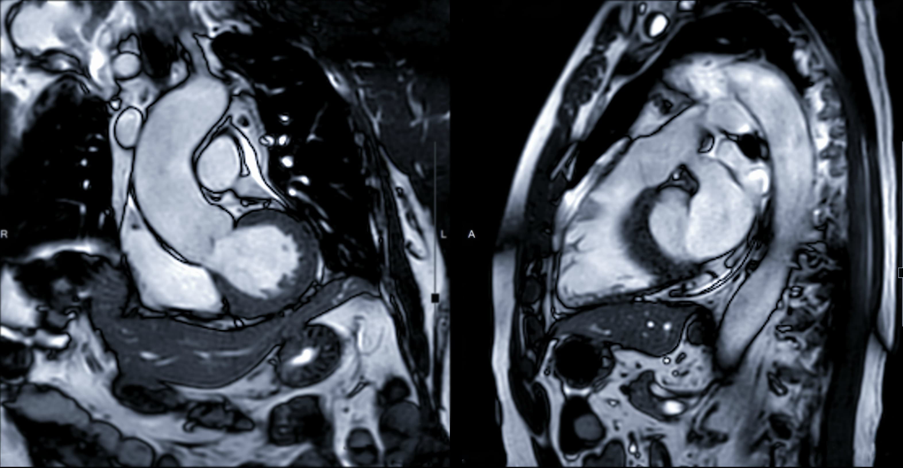 Coronary Artery Disease