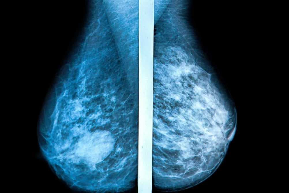 Breast Cancer Screening