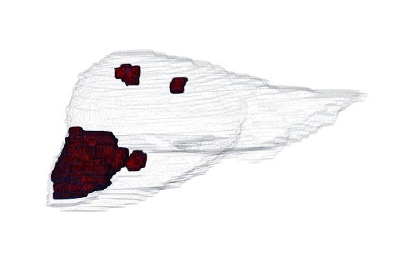 3D image of a cancerous liver